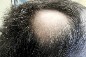 foto de parte de falha no cabelo causada por alopécia